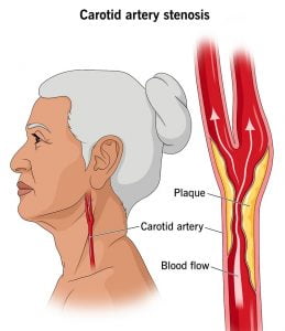 16845 carotid artery stenosis
