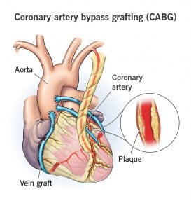 16897 bypass surgery
