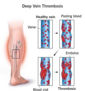 16911 deep vein thrombosis 1 1