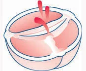 aortic valve surgery aorticbicuspid