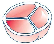 aortic valve surgery aorticclosed