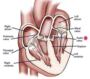 aortic valve surgery insideheartaorticvalve