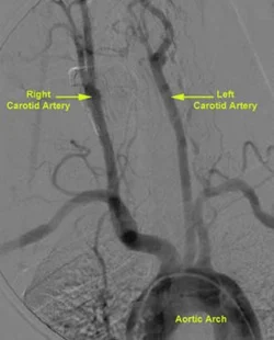 carotid stenting carotidanatomy angio