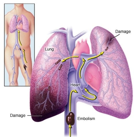 ds00223 ds00429 ds01005 im01276 mcdc7 pulmonaryembolismthu jpg