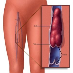 ds01005 ds00223 im00928 mcdc7 legbloodclotthu jpg