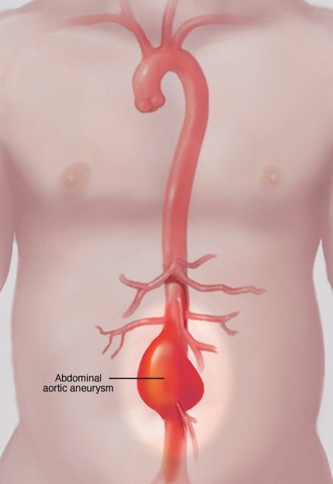 ds01194 my00076 im04478 mcdc7 abaneurysmthu jpg