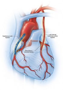 mcdc7 coronary bypass surgery 8col