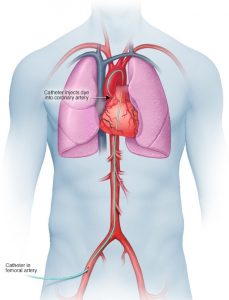 my00541 ds01209 im03723 hb7 cardiaccaththu jpg