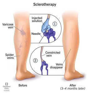 6763 sclerotherapy min