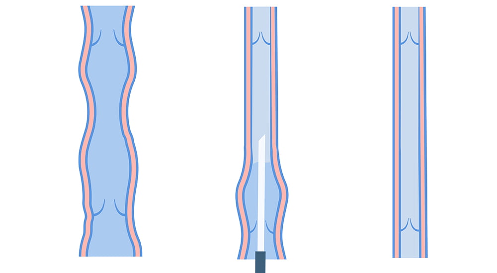 skleroterapi-islemi-ne-kadar-surer