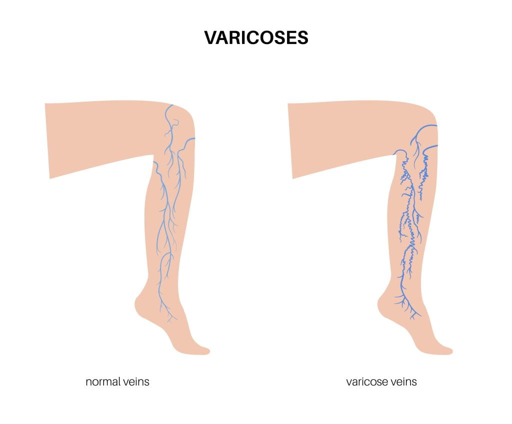 varicose_2_25-min
