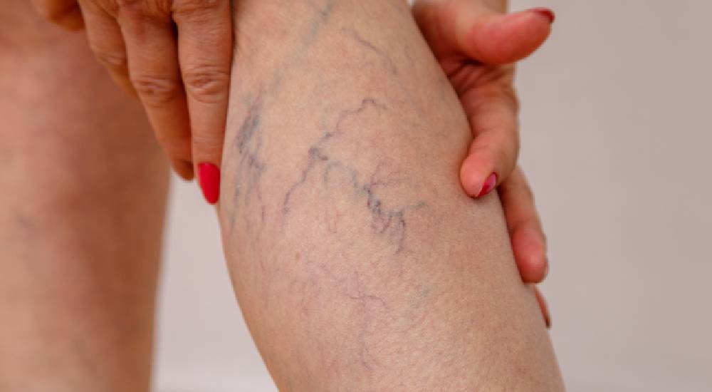 Varis Kaşıntı Yapar mı