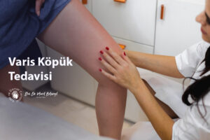 Varis Köpük Tedavisi