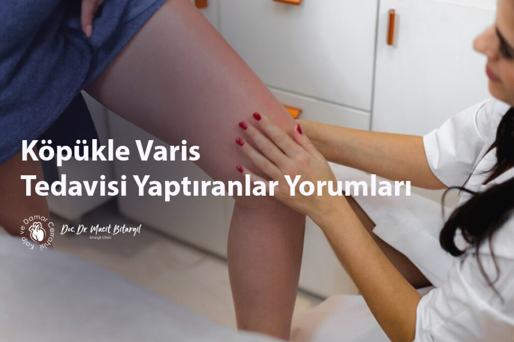 Köpükle Varis Tedavisi Yaptıranlar Yorumları