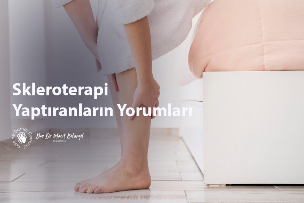 Skleroterapi Yaptıranların Yorumları