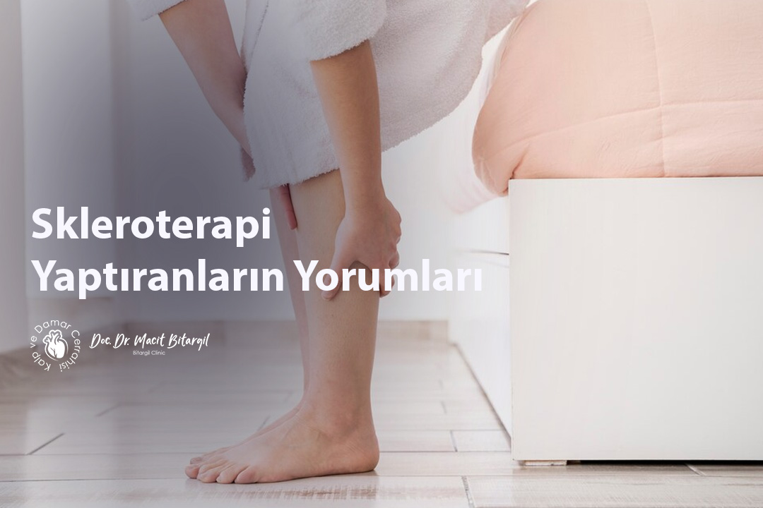 Skleroterapi Yaptıranların Yorumları