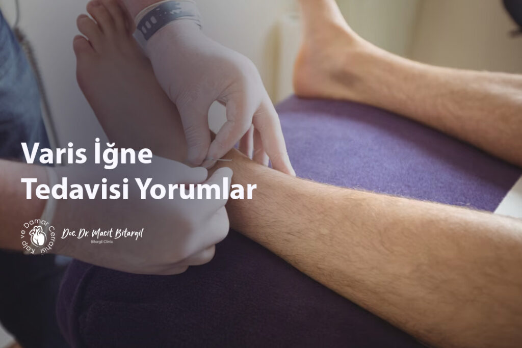 Varis İğne Tedavisi Yorumlar