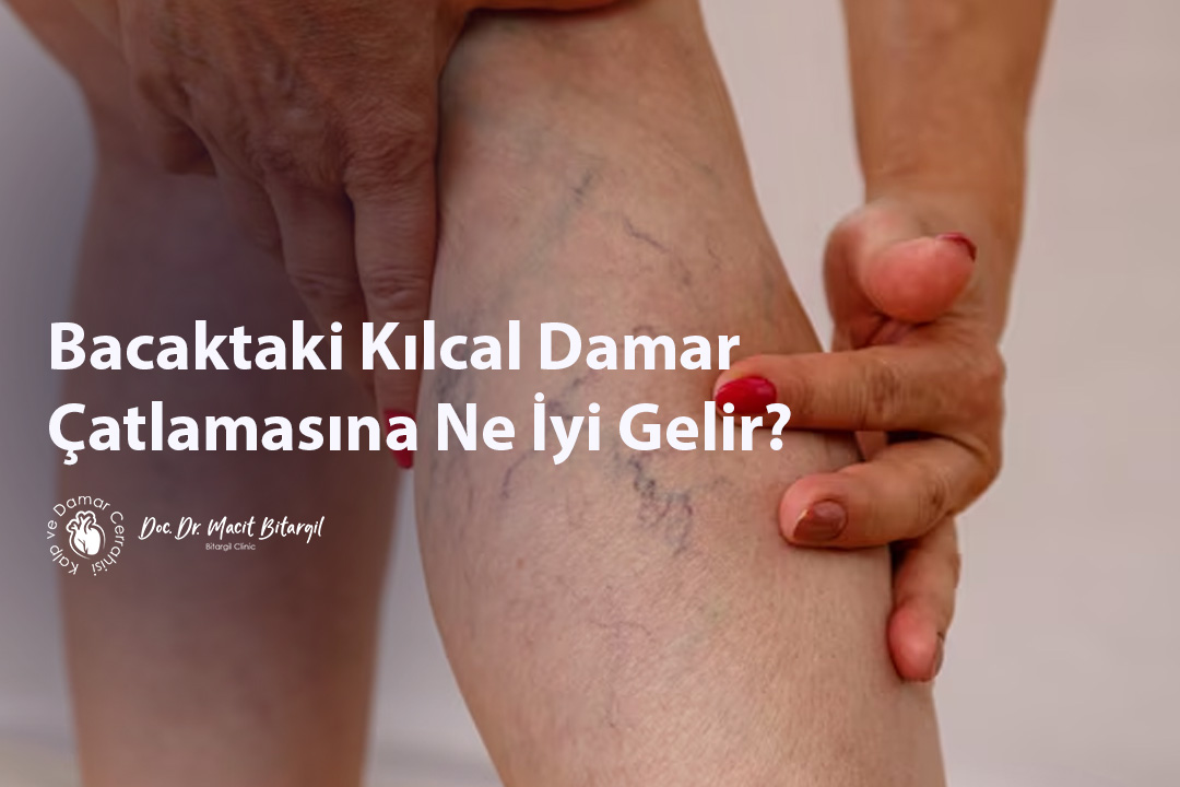 Bacaktaki Kılcal Damar Çatlamasına Ne İyi Gelir