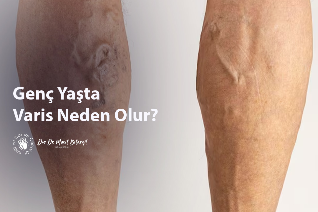 Genç Yaşta Varis Neden Olur