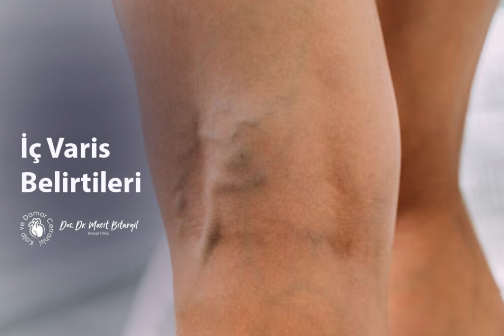 İç Varis Belirtileri