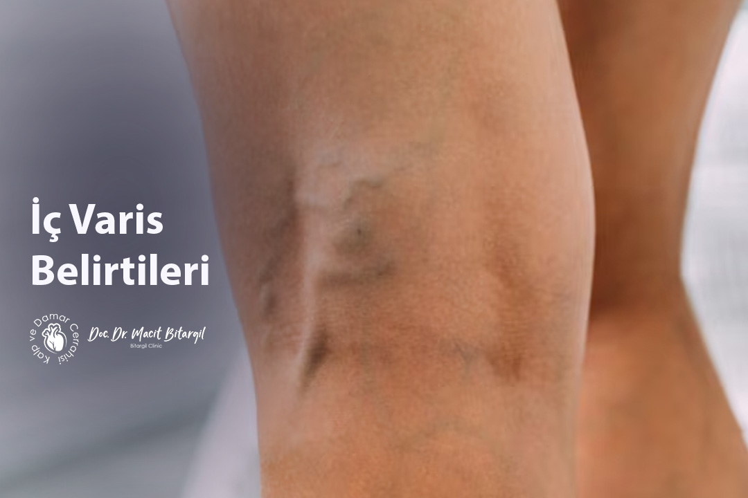 İç Varis Belirtileri