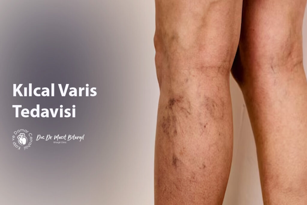 Kılcal Varis Tedavisi