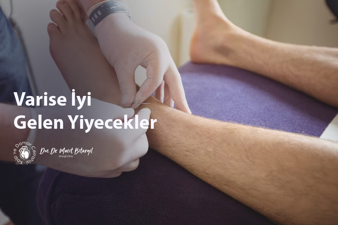 Varise İyi Gelen Yiyecekler
