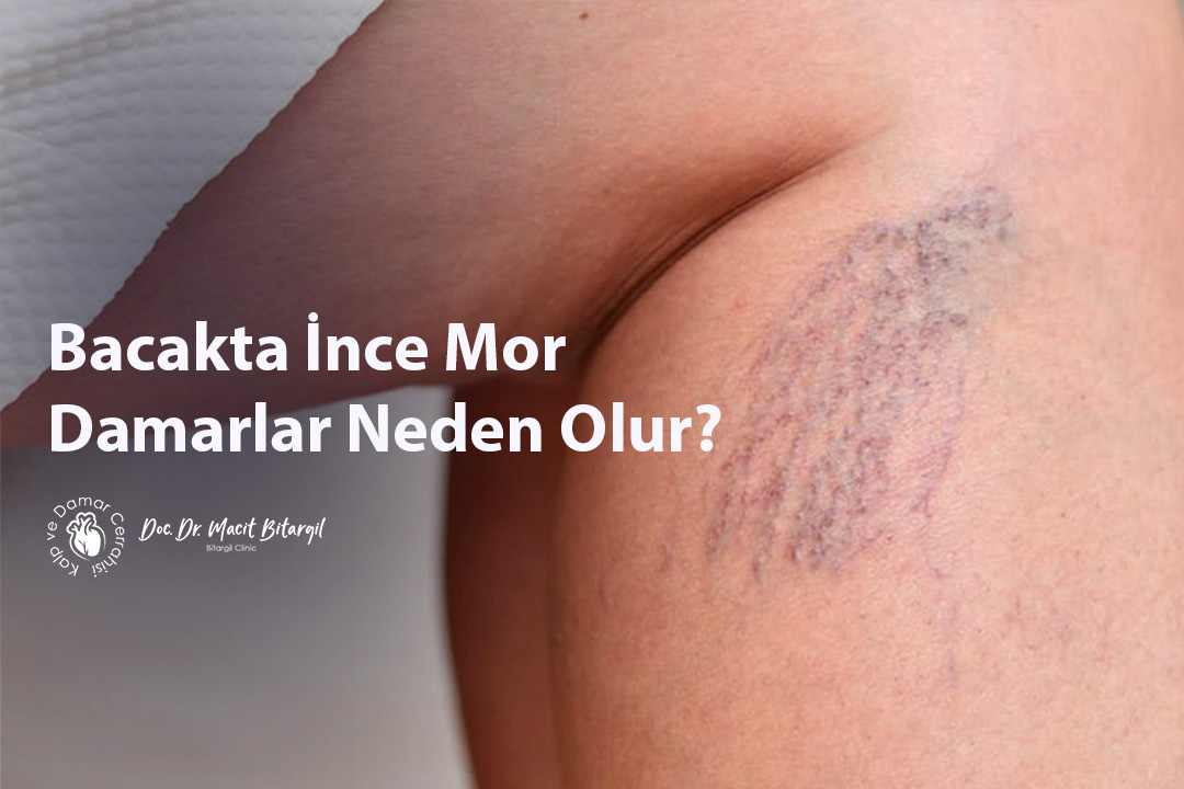 Bacakta İnce Mor Damarlar Neden Olur?