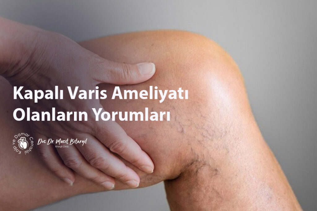 Kapalı Varis Ameliyatı Olanların Yorumları