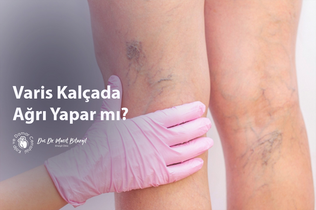 Varis Kalçada Ağrı Yapar mı?