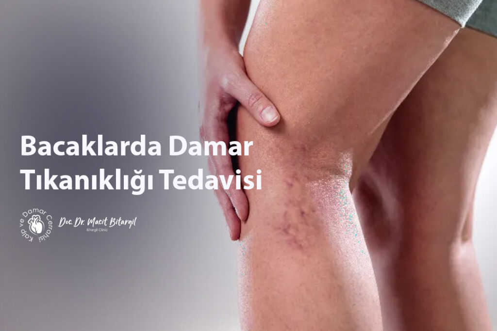 Bacaklarda Damar Tıkanıklığı Tedavisi