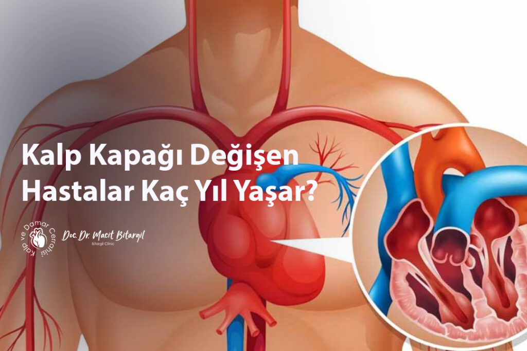 Kalp Kapağı Değişen Hastalar Kaç Yıl Yaşar?
