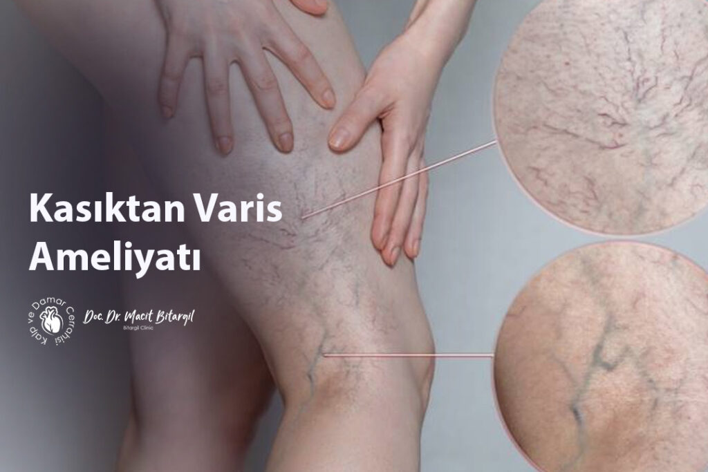 Kasıktan Varis Ameliyatı