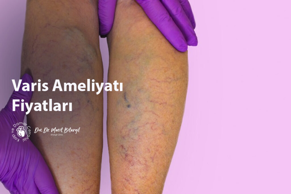 Varis Ameliyatı Fiyatları