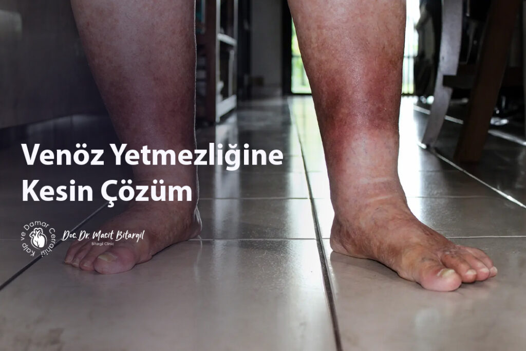 Venöz Yetmezliğine Kesin Çözüm