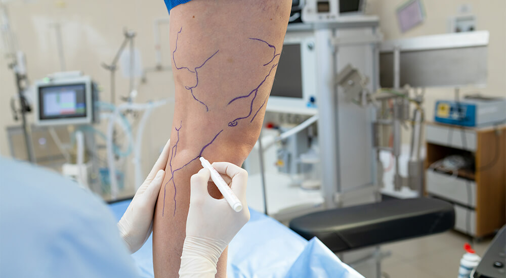 varis tedavisinde beslenme nasil olmalidir