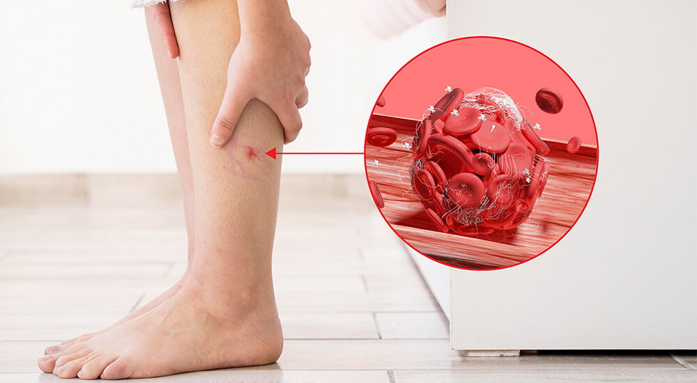 varisler damar tikanikligi yapar mi